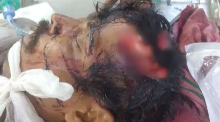 प्रेम विवाह से नाराज पति ने किया हमला, पिता-पुत्र समेत तीन घायल, 10 दिन पहले हुआ था समझौता